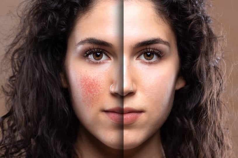 Rosacea 101: Symptoms, Causes, and Effective Treatments - A Comprehensive Guide