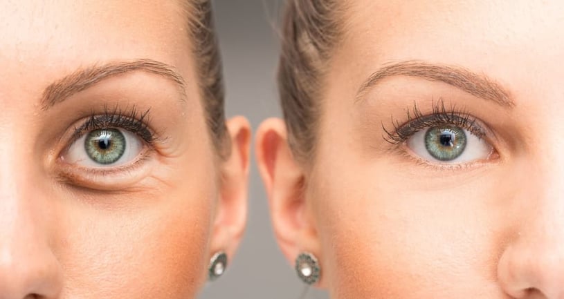 Crows Feet: What Is It and How To Treat It With Botox?
