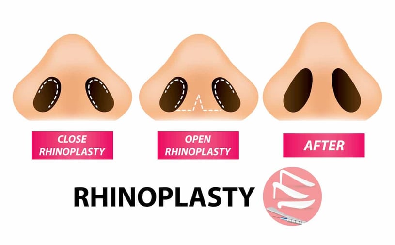 Rhinoplasty in Houston: Open vs Closed Surgical Approach