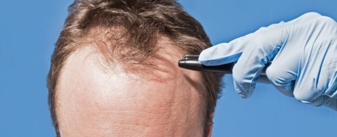 3 Popular Hair Restoration Techniques