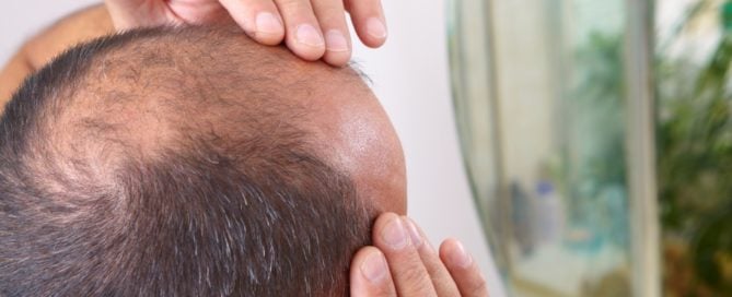 Guys & All Things Male Pattern Hair Loss