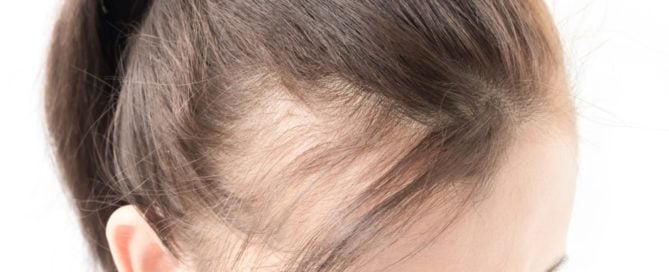 Should I Get PRP for Hair Loss?
