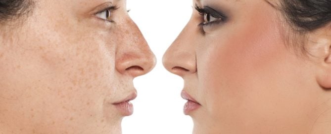 What Rhinoplasty Can & Cannot Accomplish
