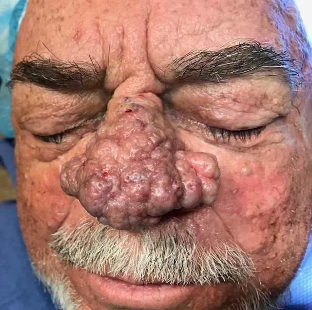 Rhinophyma pre laser surgery